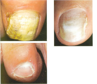 Nagelpilz